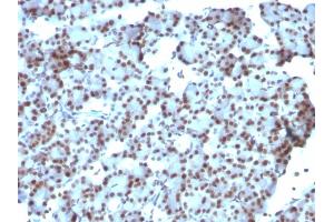 Formalin-fixed, paraffin-embedded human Ovarian Carcinoma stained with SUMO-1 Monoclonal Antibody (SUMO1/1188) (SUMO1 antibody)