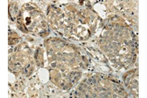 The image on the left is immunohistochemistry of paraffin-embedded Human breast cancer tissue using ABIN7128017(SIAH1 Antibody) at dilution 1/35, on the right is treated with fusion protein. (SIAH1 antibody)