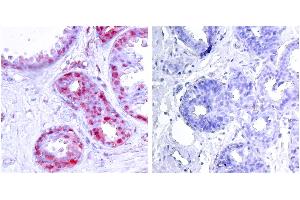 P-Peptide - +Immunohistochemical analysis of paraffin-embedded human breast carcinoma tissue using c-Jun (phospho-Ser243) antibody. (C-JUN antibody  (pSer243))
