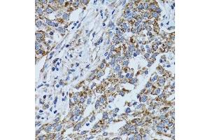 Immunohistochemistry of paraffin-embedded human lung cancer using ATP5B antibody. (ATP5B antibody  (AA 230-529))