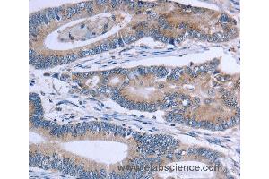 Immunohistochemistry of Human colon cancer using SLC1A6 Polyclonal Antibody at dilution of 1:40 (SLC1A6 antibody)