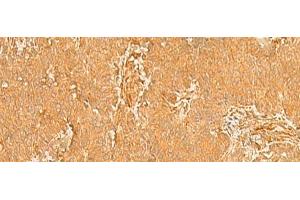 Immunohistochemistry of paraffin-embedded Human breast cancer tissue using KRT76 Polyclonal Antibody at dilution of 1:50(x200) (Cytokeratin 2 antibody)