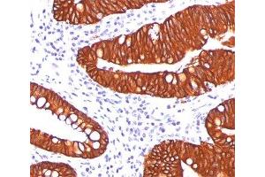 IHC testing of colon carcinoma stained with Cytokeratin 19 antibody (A53-B/A2. (Cytokeratin 19 antibody)