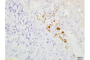 Formalin-fixed and paraffin embedded human endometrial cancer labeled with Anti-S100B/S100 beta Polyclonal Antibody, Unconjugated (ABIN1387393) followed by conjugation to the secondary antibody and DAB staining (S100B antibody)