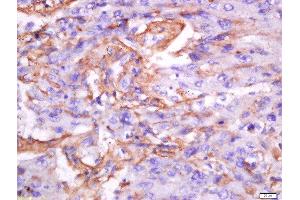 Paraformaldehyde-fixed, paraffin embedded human lung carcinoma tissue, Antigen retrieval by boiling in sodium citrate buffer(pH6) for 15min, Block endogenous peroxidase by 3% hydrogen peroxide for 30 minutes, Blocking buffer (normal goat serum) at 37°C for 20min, Antibody incubation with Rabbit Anti-Exportin-2 Polyclonal Antibody, Unconjugated  at 1:200 overnight at 4°C, followed by a conjugated secondary and DAB staining (Exportin 2 antibody  (AA 901-971))