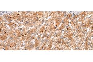 Immunohistochemistry of paraffin-embedded Human liver cancer tissue using GPC4 Polyclonal Antibody at dilution of 1:30(x200) (GPC4 antibody)