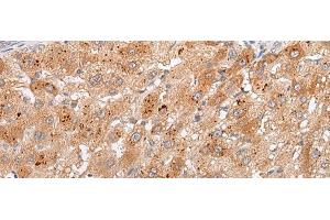 Immunohistochemistry of paraffin-embedded Human liver cancer tissue using GPC4 Polyclonal Antibody at dilution of 1:30(x200) (GPC4 antibody)