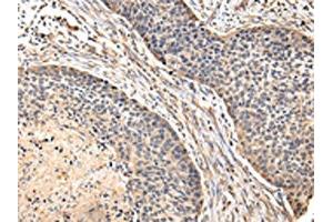 The image on the left is immunohistochemistry of paraffin-embedded Human esophagus cancer tissue using ABIN7128083(VIP Antibody) at dilution 1/20, on the right is treated with fusion protein. (Vip antibody)