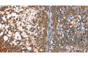 Immunohistochemistry of paraffin-embedded Human cervical cancer using MAD2L1BP Polyclonal Antibody at dilution of 1:65 (MAD2L1BP antibody)