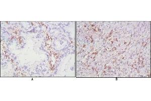 Immunohistochemical analysis of paraffin-embedded human lung cancer (A), lymphonodus tissue (B),showing cytomembrane localization using CD38 antibody with DAB staining. (CD38 antibody)
