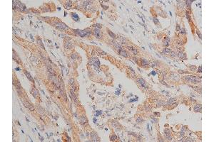 ABIN6267517 at 1/50 staining human lung cancer tissue sections by IHC-P. (MTOR antibody  (pSer2448))