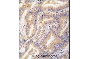 Formalin-fixed and paraffin-embedded human lung carcinoma tissue reacted with Autophagy G12L antibody (N-term) 1816a , which was peroxidase-conjugated to the secondary antibody, followed by DAB staining.