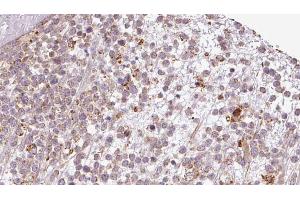 ABIN6273199 at 1/100 staining Human lymph cancer tissue by IHC-P. (BAMBI antibody  (Internal Region))