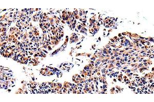 Immunohistochemistry of paraffin-embedded Human lung cancer using AKR1B1 Polyclonal Antibody at dilution of 1:40 (AKR1B1 antibody)