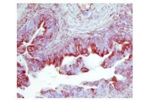 TIMP2 in human ovarian cancer was detected using HRP/AEC red color stain (TIMP2 antibody  (Middle Region))