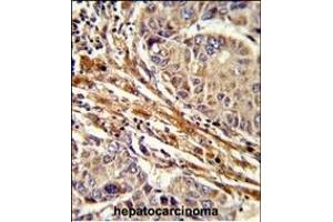 Formalin-fixed and paraffin-embedded human hepatocarcinoma reacted with RT Antibody (C-term), which was peroxidase-conjugated to the secondary antibody, followed by DAB staining. (APRT antibody  (C-Term))