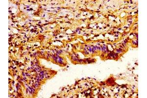IHC image of ABIN7168784 diluted at 1:300 and staining in paraffin-embedded human lung cancer performed on a Leica BondTM system. (SEMA3A antibody  (AA 357-445))
