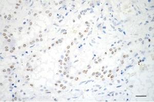 Immunohistochemistry was performed on paraffin-embedded human lung adenocarcinoma using ADAM17 antibody (ABIN7797502), 1:200).