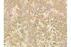 ABIN6260454 and ABIN6272856 at 1/100 staining human melanoma by IHC-P. (Caprin-1 antibody  (Internal Region))