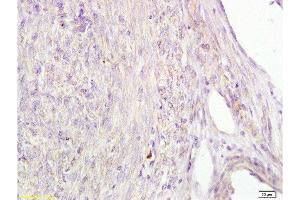 Formalin-fixed and human cervical carcinoma tissue labeled with Anti-AFP Polyclonal Antibody (bsm-1621M) , Unconjugated1:100 followed by conjugation to the secondary antibody and DAB staining (alpha Fetoprotein antibody)