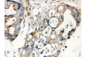 Anti- Plectin Picoband antibody, IHC(P) IHC(P): Human Intestinal Cancer Tissue (PLEC antibody  (Middle Region))