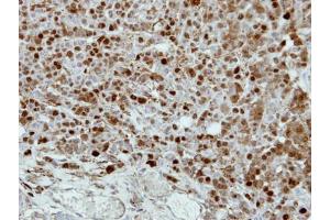 IHC-P Image Immunohistochemical analysis of paraffin-embedded MDAMB468 xenograft, using CRABP2, antibody at 1:500 dilution. (CRABP2 antibody)