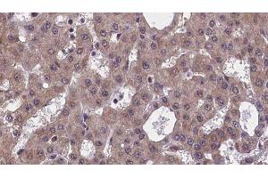 ABIN6277562 at 1/100 staining Human liver cancer tissue by IHC-P. (AP2A2 antibody  (Internal Region))