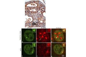 Formalin-fixed and paraffin-embedded human cancer tissue reacted with the primary antibody, which was peroxidase-conjugated to the secondary antibody, followed by DAB staining. (SETD2 antibody  (N-Term))