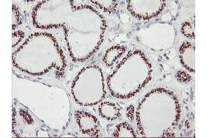 Immunohistochemical staining of paraffin-embedded Carcinoma of Human thyroid tissue using anti-GOLM1 mouse monoclonal antibody.