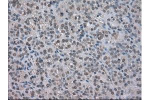 Immunohistochemical staining of paraffin-embedded Carcinoma of kidney tissue using anti-NAT8mouse monoclonal antibody. (NAT8 antibody)