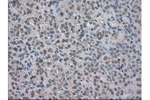 Immunohistochemical staining of paraffin-embedded Carcinoma of kidney tissue using anti-NAT8mouse monoclonal antibody.