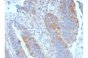 Formalin-fixed, paraffin-embedded human Colon Carcinoma stained with Calpain 1 Mouse Monoclonal Antibody (CAPN1/1530). (CAPNL1 antibody)