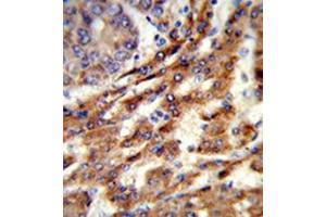 Formalin-fixed and paraffin-embedded human hepatocarcinoma reacted with ERGIC3 Antibody (N-term) followed which was peroxidase-conjugated to the secondary antibody, followed by DAB staining. (ERGIC3 antibody  (N-Term))