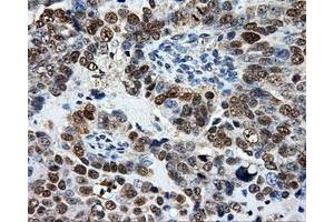 Immunohistochemical staining of paraffin-embedded Adenocarcinoma of breast tissue using anti-ATP5B mouse monoclonal antibody. (ATP5B antibody)