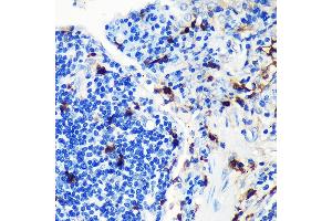 Immunohistochemistry of paraffin-embedded human lung cancer using S100 Rabbit mAb (ABIN7270128) at dilution of 1:100 (40x lens).
