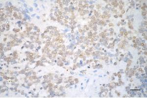 Immunohistochemistry was performed on paraffin-embedded human breast carcinoma using PADI2 antibody (ABIN7799756), 1:200).