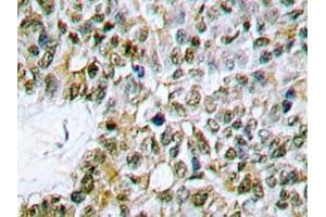 Immunohistochemistry analyzes of Caspase 9 antibody in paraffin-embedded human lung carcinoma tissue. (Caspase 9 antibody)