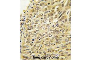 Formalin-fixed and paraffin-embedded human lung carcinoma tissue reacted with UBQLN2 polyclonal antibody  , which was peroxidase-conjugated to the secondary antibody, followed by DAB staining. (Ubiquilin 2 antibody  (N-Term))