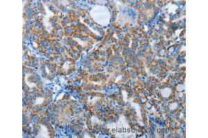 Immunohistochemistry of Human thyroid cancer using AGL Polyclonal Antibody at dilution of 1:30