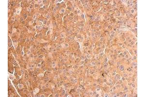 IHC-P Image Cofilin 1 antibody detects CFL1 protein at cytosol on HBL435 xenograft by immunohistochemical analysis. (Cofilin antibody)