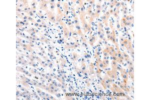Immunohistochemistry of Human liver cancer using MTOR Polyclonal Antibody at dilution of 1:60 (MTOR antibody)