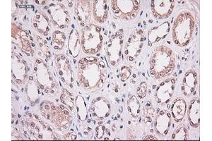Immunohistochemical staining of paraffin-embedded Carcinoma of lung using anti-Stat4 (ABIN2452527) mouse monoclonal antibody. (STAT4 antibody  (AA 633-652))