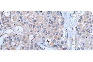 Immunohistochemistry of paraffin-embedded Human esophagus cancer tissue using YPEL5 Polyclonal Antibody at dilution of 1:60(x200) (YPEL5 antibody)
