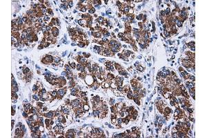 Immunohistochemical staining of paraffin-embedded Adenocarcinoma of endometrium tissue using anti-ATP5Bmouse monoclonal antibody. (ATP5B antibody)