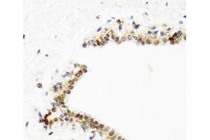 Immunohistochemistry of paraffin-embedded Human breast using TOP1 Polyclonal Antibody at dilution of 1:100 (40x lens). (Topoisomerase I antibody)