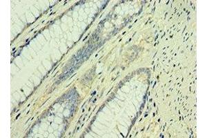 Immunohistochemistry of paraffin-embedded human colon cancer using ABIN7171560 at dilution of 1:100 (TAF1B antibody  (AA 369-588))