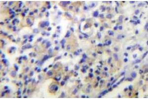 Immunohistochemistry (IHC) analyzes of TPH1 antibody in paraffin-embedded human lung carcinoma tissue. (Tryptophan Hydroxylase 1 antibody)