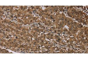 Immunohistochemistry of paraffin-embedded Human liver cancer tissue using MEIS1 Polyclonal Antibody at dilution 1:30 (MEIS1 antibody)