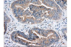 Immunohistochemical staining of paraffin-embedded Adenocarcinoma of Human colon tissue using anti-IGF2BP2 mouse monoclonal antibody.