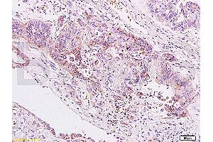 Formalin-fixed and paraffin embedded human gastric carcinoma labeled Anti-B7H4 Polyclonal Antibody, Unconjugated (ABIN671736) at 1:200, followed by conjugation to the secondary antibody and DAB staining